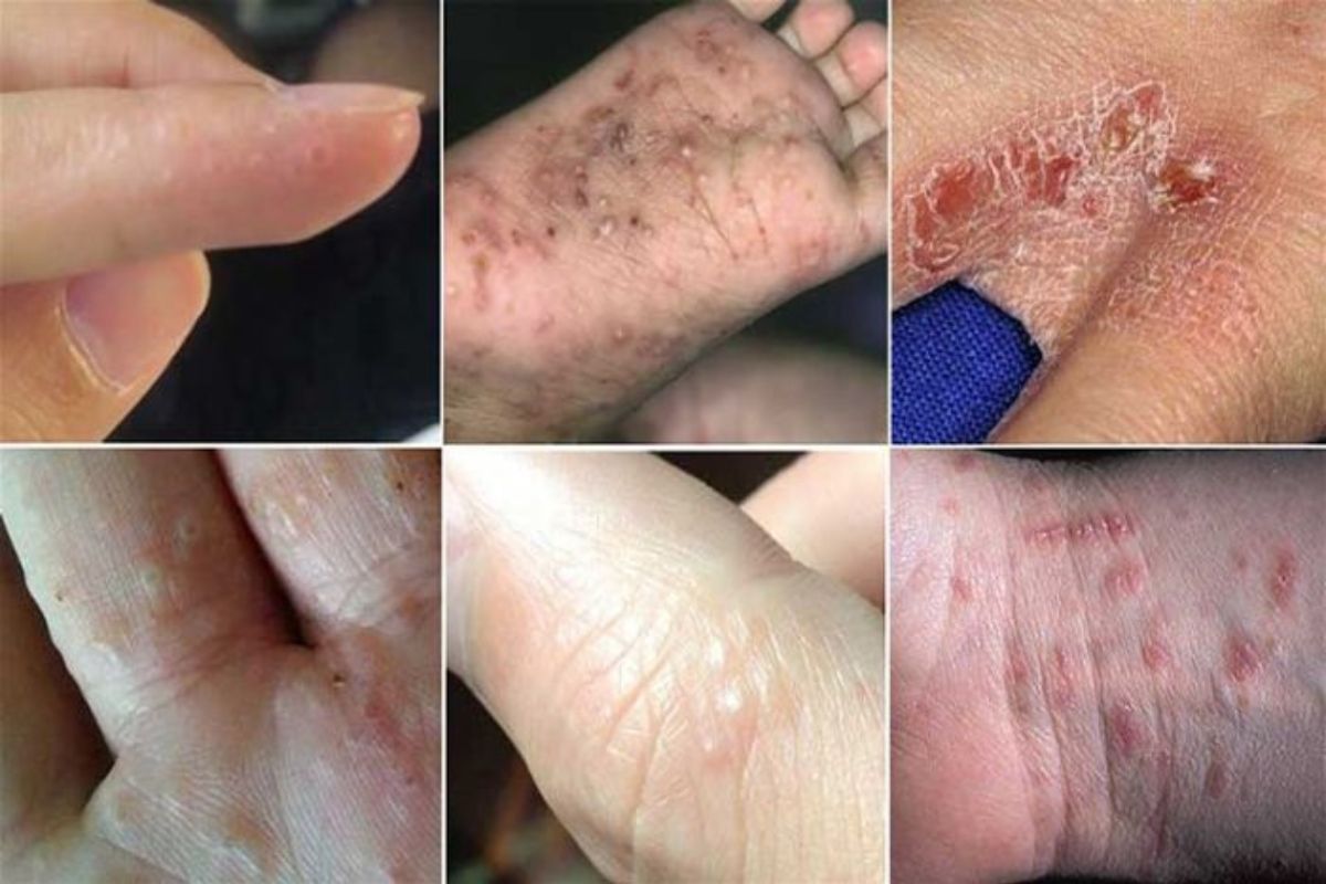 Nước nhiễm phèn và cách xử lý nước nhiễm phèn bằng lọc tổng đầu nguồn